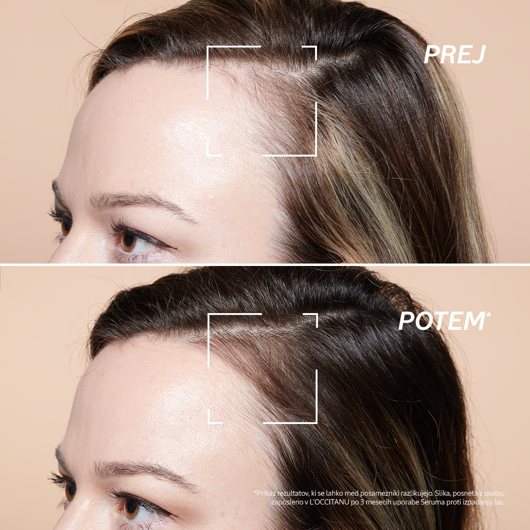 Serum proti izpadanju las